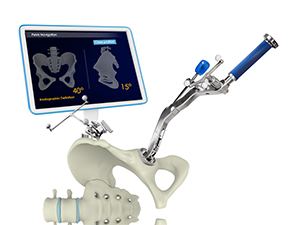 Computer-Navigated Total Hip Replacement