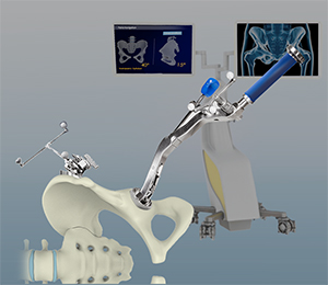 Computer-assisted Hip Replacement