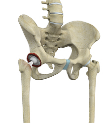 Correction of a Failed Hip Replacement