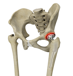 Correction of a Painful Hip Replacement