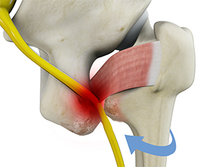 Ischiofemoral Impingement Decompression - Procedure