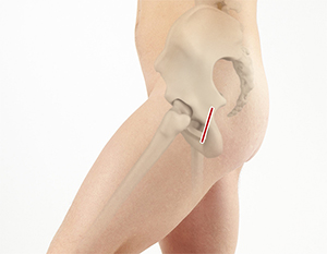 SuperPath Hip Replacement