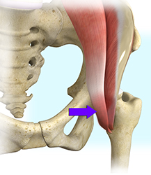 Surgical Release of Iliopsoas Tendon