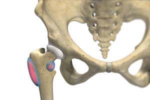 Physical Therapy in Middleton for Hip - Trochanteric Bursitis Surgery