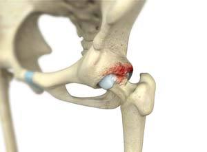 Hip Fracture Surgery