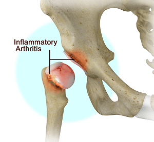 Exercise for Arthritis